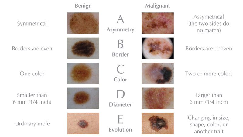 Melanoma ABCDE