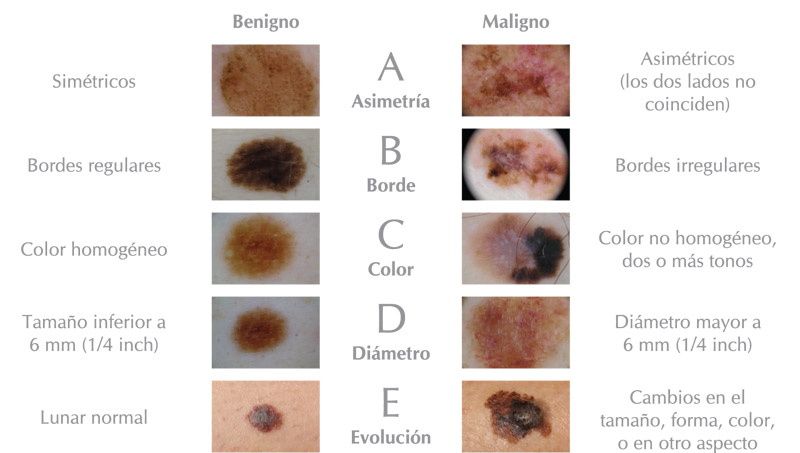 ABCDE Melanoma