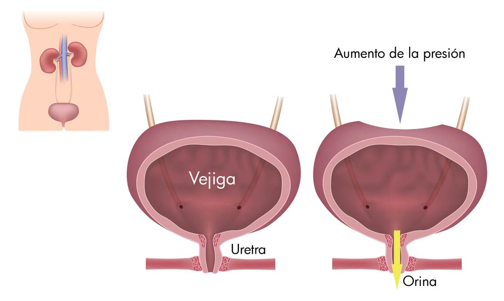 Incontinencia Urinaria