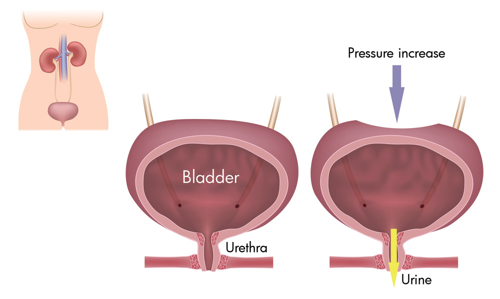 Incontinence