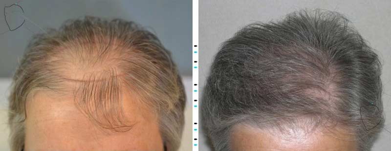 crecimiento_pelo_02