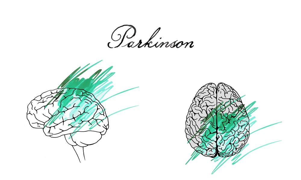 parkinson