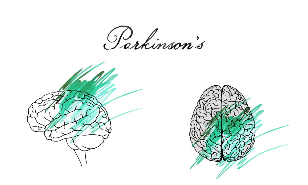 parkinson's