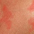 Dermatitis Atópica Marbella