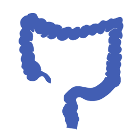 Colon cancer