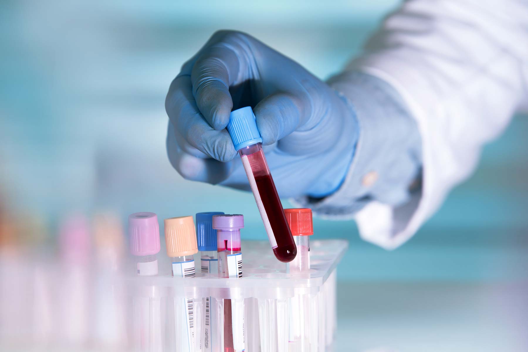 Diagnóstico Hematología HC Marbella HC Marbella International Hospital