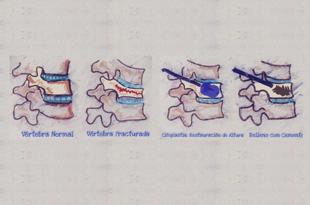 Cifoplastia