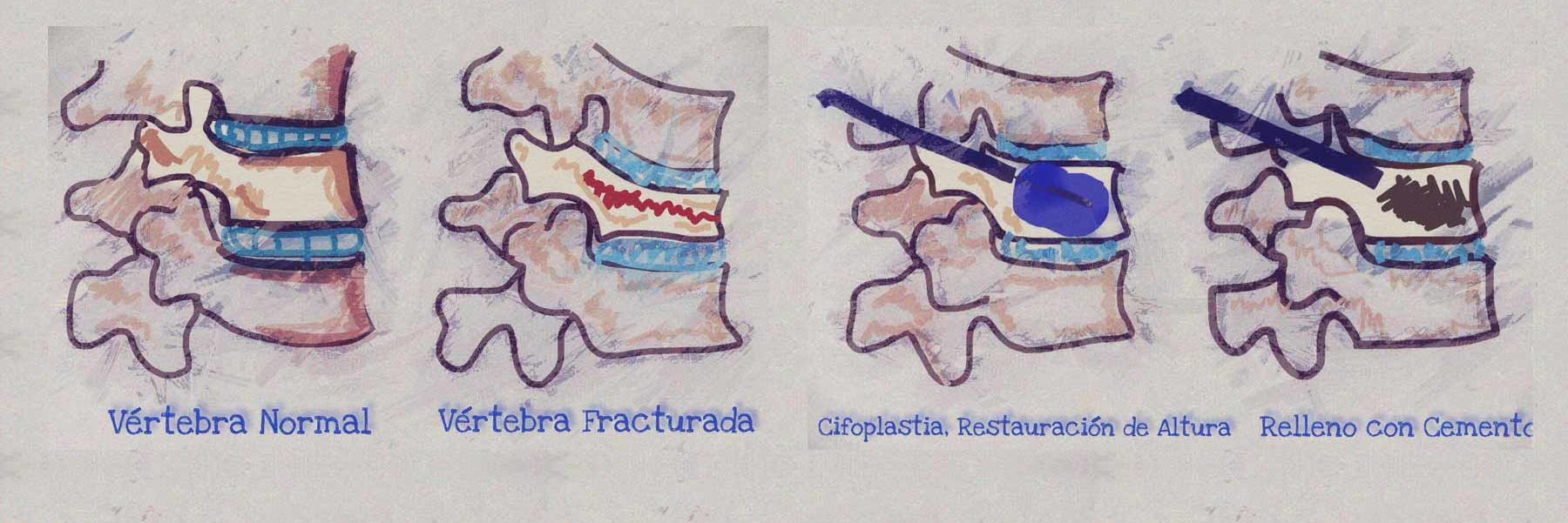 Cifoplastia