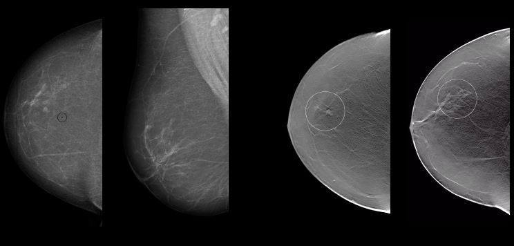 Tomosíntesis y mamografía