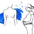 Embarazo tras cáncer de mama