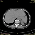 Imagen corte axial del abdomen