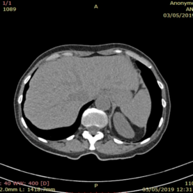 Imagen corte axial del abdomen