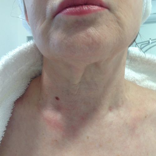 Medicina Estética tramiento Radiesse