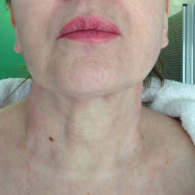 Tratamiento cuello medicina estética