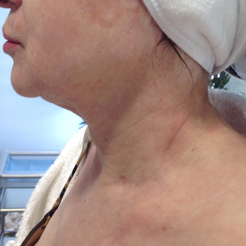 Tratamiento cuello Ácido Hialurónico