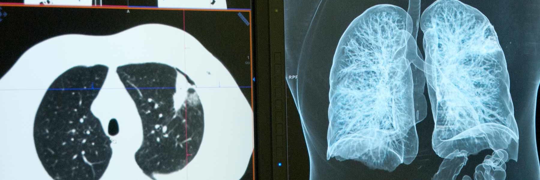 Detección precoz cáncer de pulmón