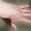 dermatitis por lavado de manos