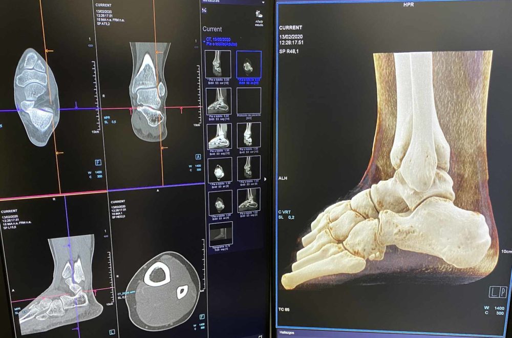 foot surgery