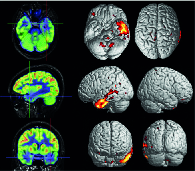 pet tac pacientes neuro