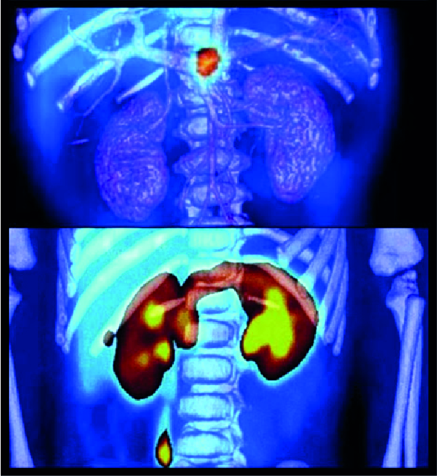 pet para pacientes oncologicos