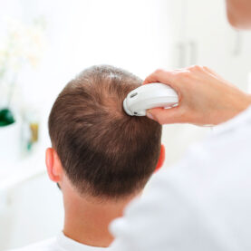 tratamientos alopecia
