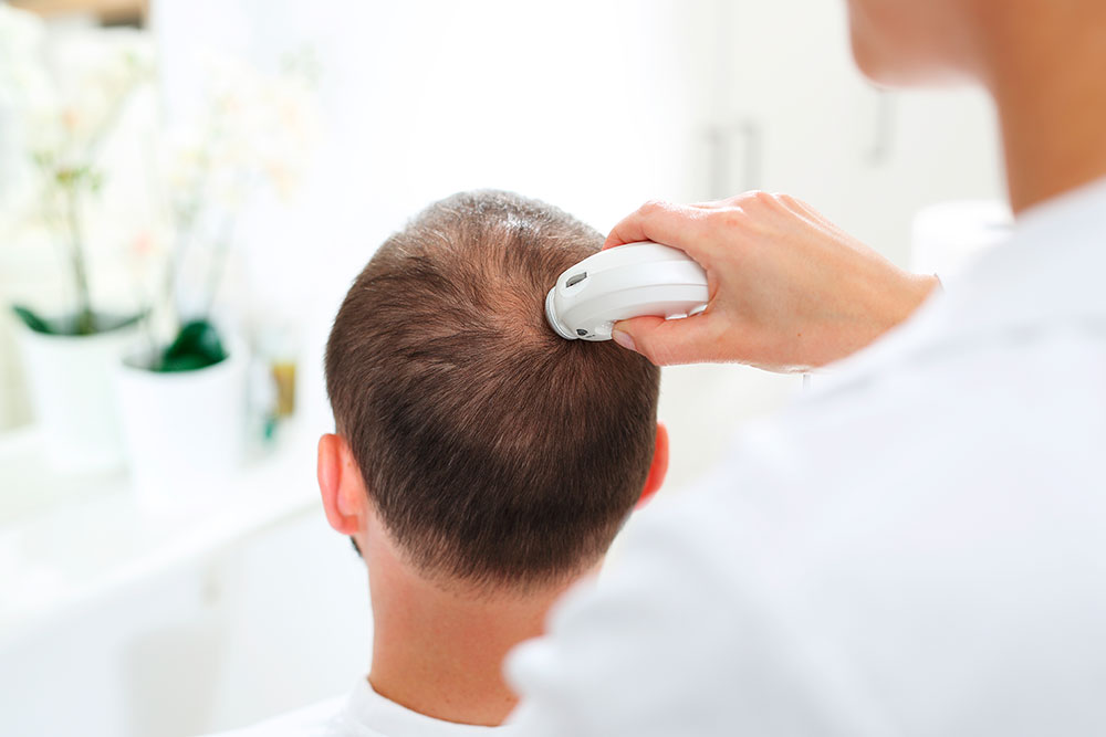 tratamientos alopecia