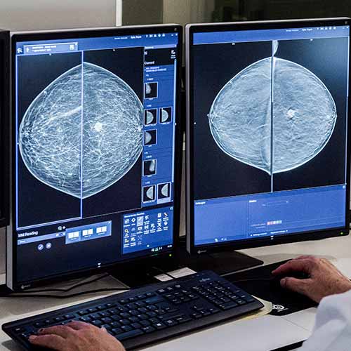 mamografÍa biopsia