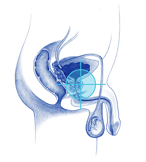 hormonoterapia_prostata