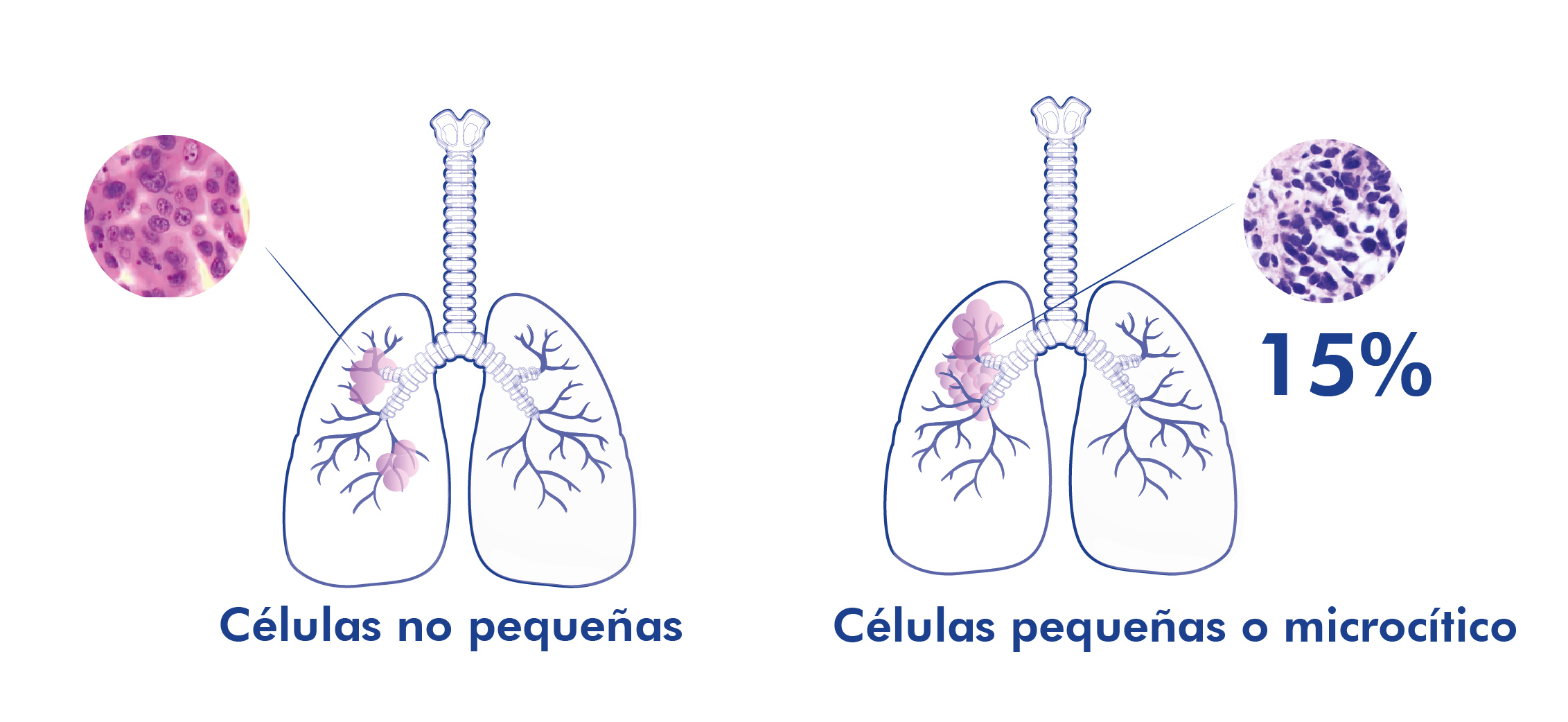 tipos de cáncer de pulmon