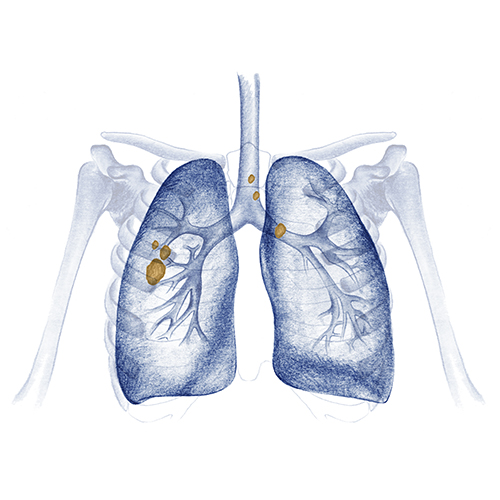 cáncer de pulmón estadio III