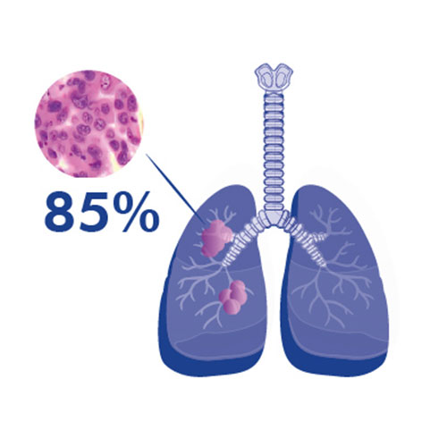 cancer pulmón no microcítico