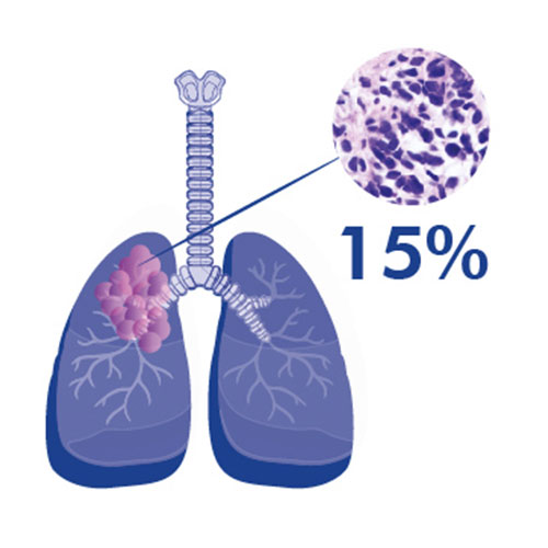 cancer de pulmon de células pequeñas