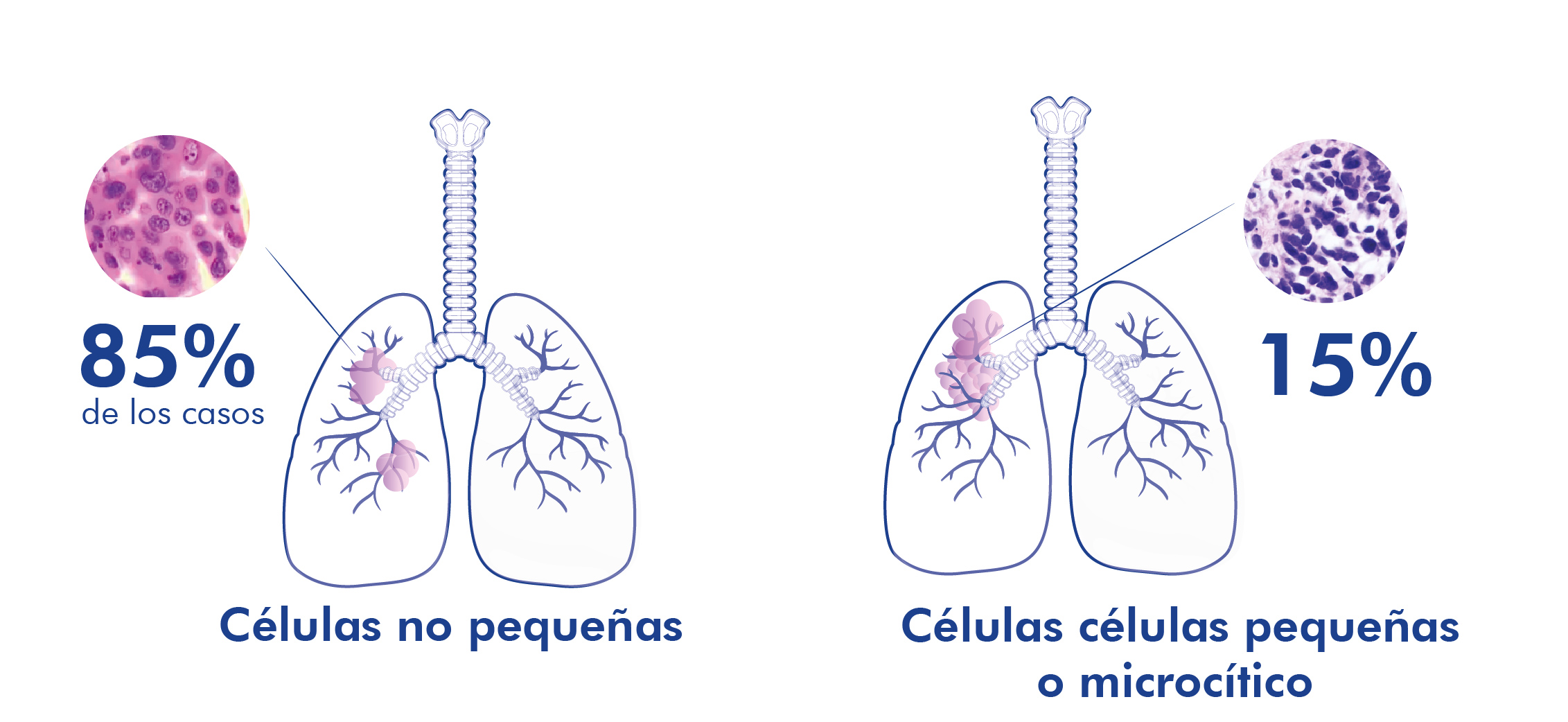 tipos de cáncer de pulmon