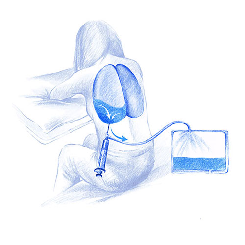 toracentesis