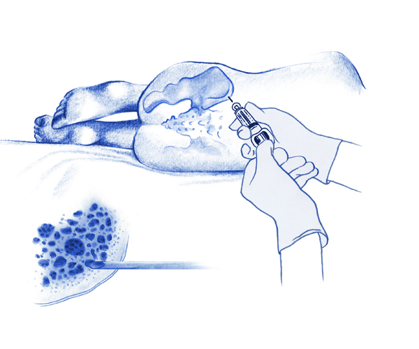 biopsia de medula