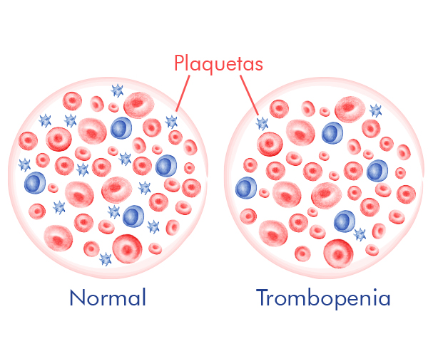 trombopenia