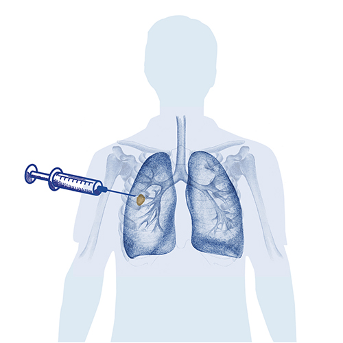 biopsia pulmonar