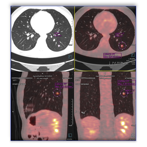 PET TC pulmón
