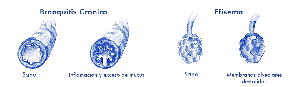 tipos_EPOC
