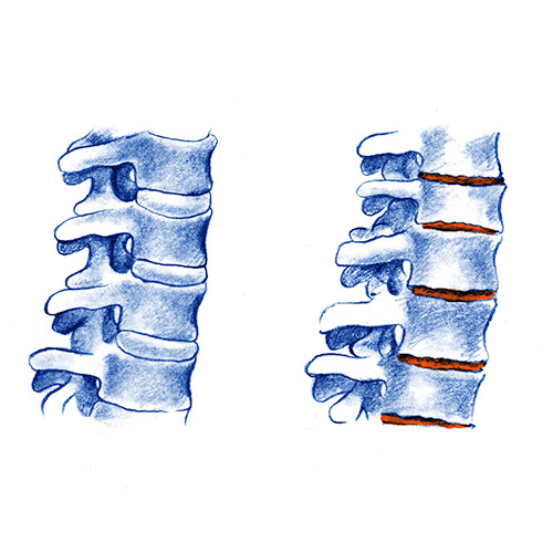 artropatías inflamatorias