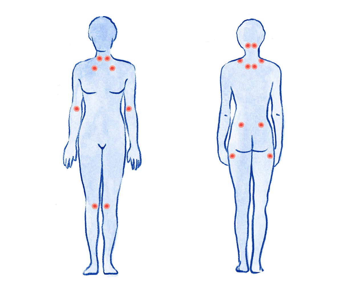 fibromialgia