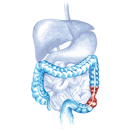 colon irritable