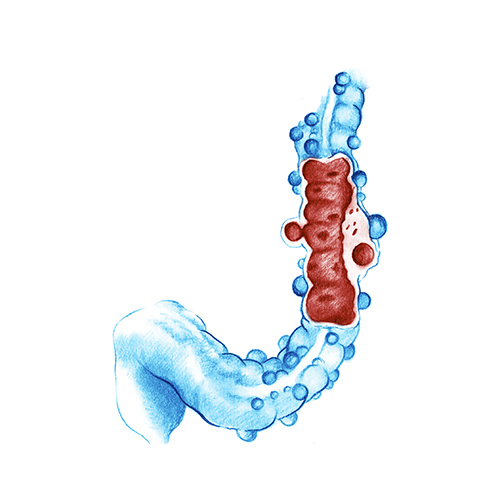 tratamiento diverticulitis