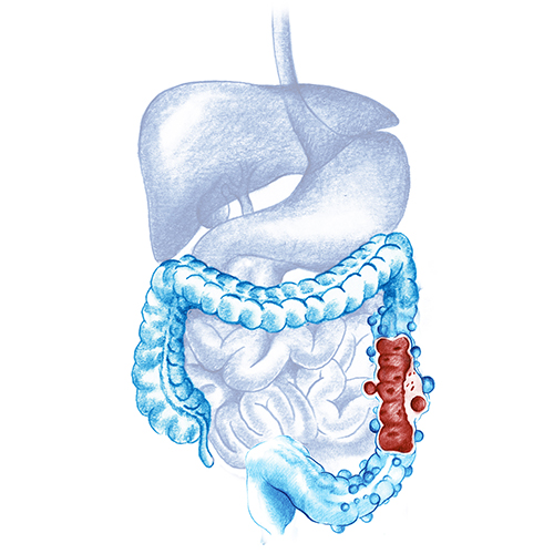 diverticulitis