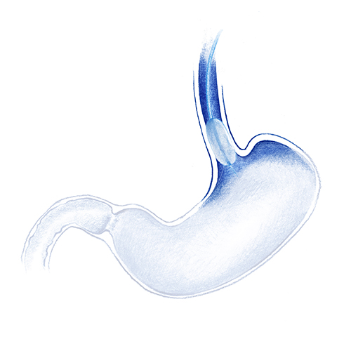 esofagitis-eosinofilica