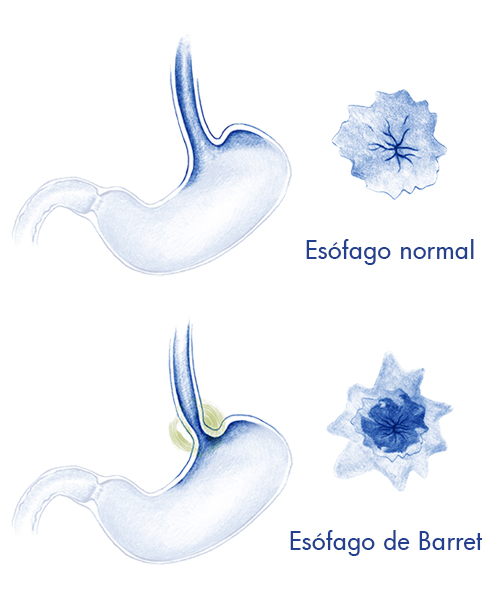 esófago-de-Barret