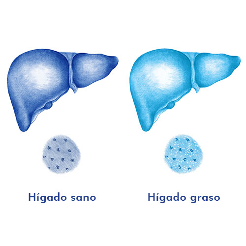 Enfermedad-Hepática-Metabólica-Grasa EHmet