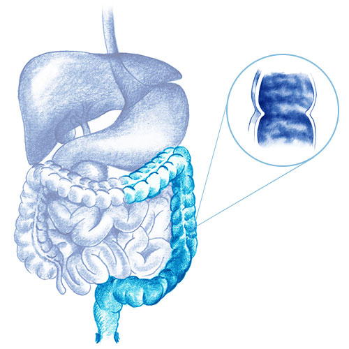 Colitis ulcerosa