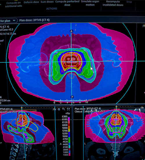 Radioterapia de intensidad modulada