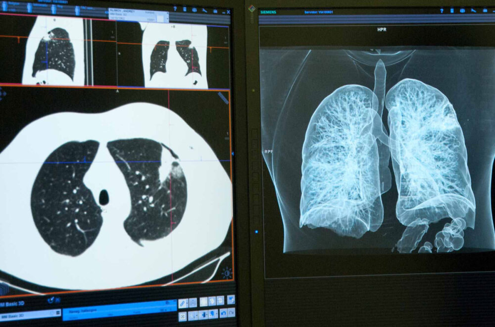 deteccion_cancer-de-pulmon